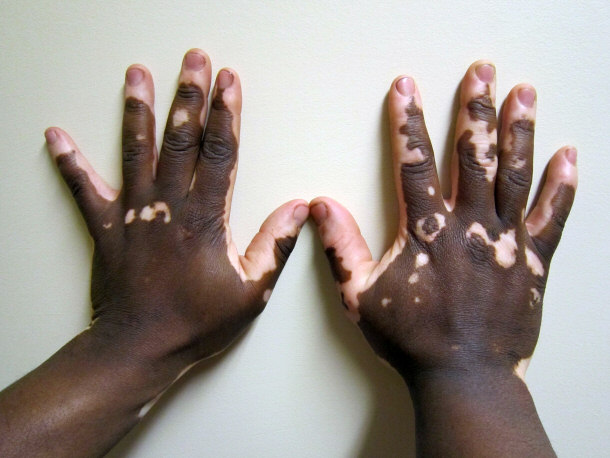 Vitiligo of the Hand