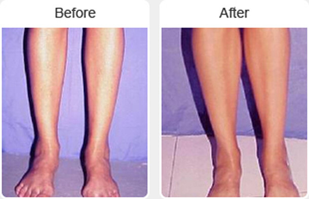 Calf Implants - Before and after