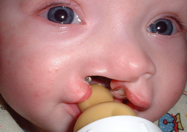 Baby With Cleft Palate Nursing