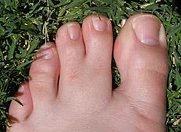 fused toes Pre-Operative Webbed Toes